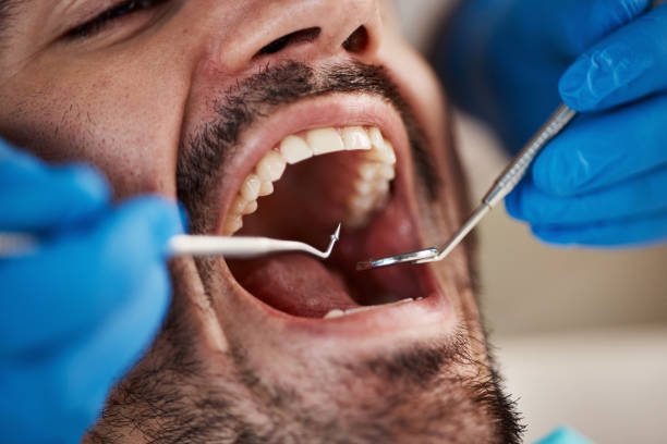 Best Emergency Dentist for Lost Fillings or Crowns in Newville, PA